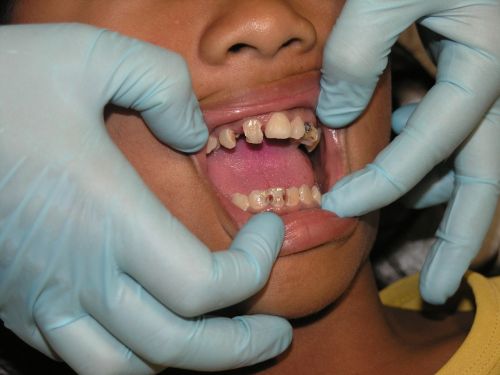 bad teeth toothache dental treatment