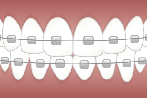 braces  teeth  dentist