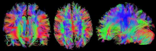 brain mrt magnetic resonance imaging