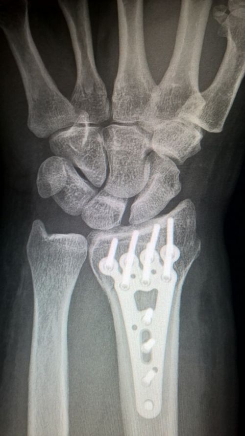 broken arm plate fixation titanium plate