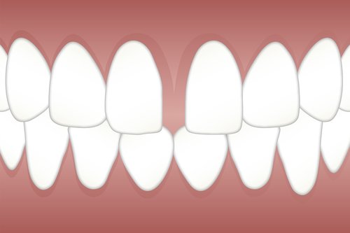 dental  diastema  space