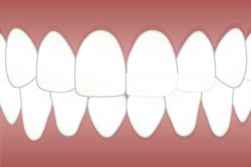 dental  fluorosis  mottled