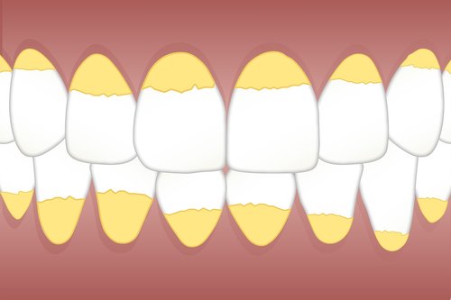 dental  calculus  teeth