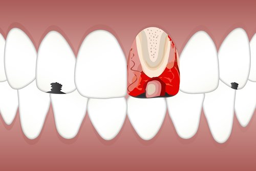 dental  pulpitis  white