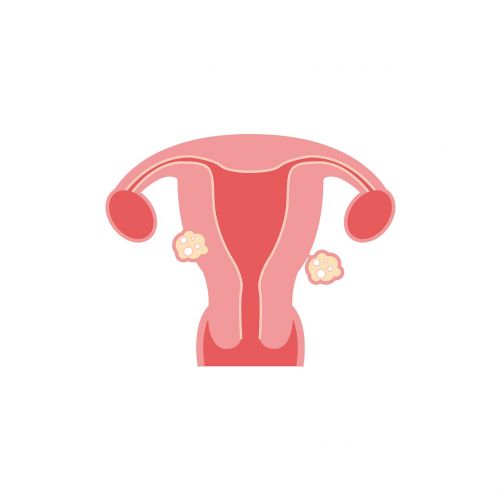 fibroids fibroids model fibroids types