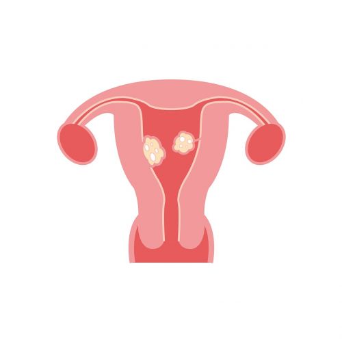 fibroids fibroids model fibroids types