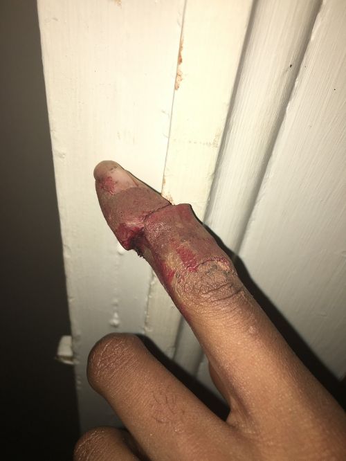 finger injury broken