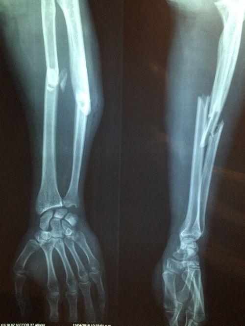 fracture bone xray skeleton