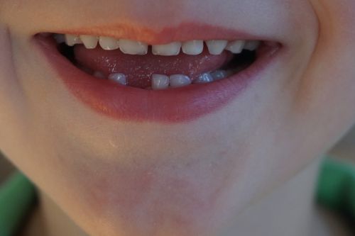 gap milk tooth child