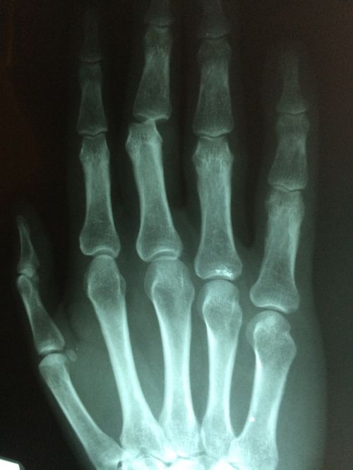 hand fracture broken