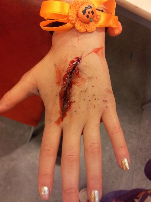hand wound blood