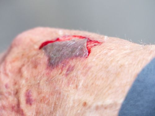 hand injury wound