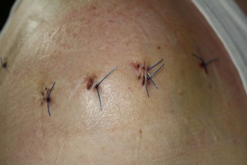 operation stitches sew