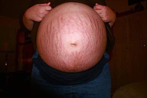 pregnant pregnancy stretch marks