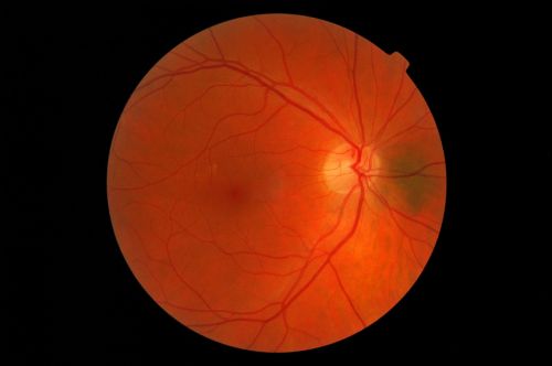 retina nevus eye