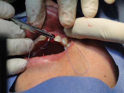 surgery teeth operation