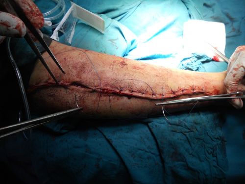 surgery orthopedic arm