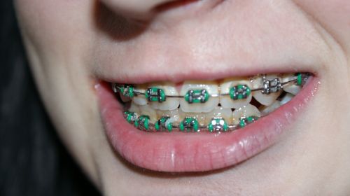 tooth dental braces bite