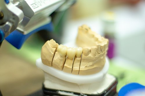 tooth replacement  dentist  healthcare