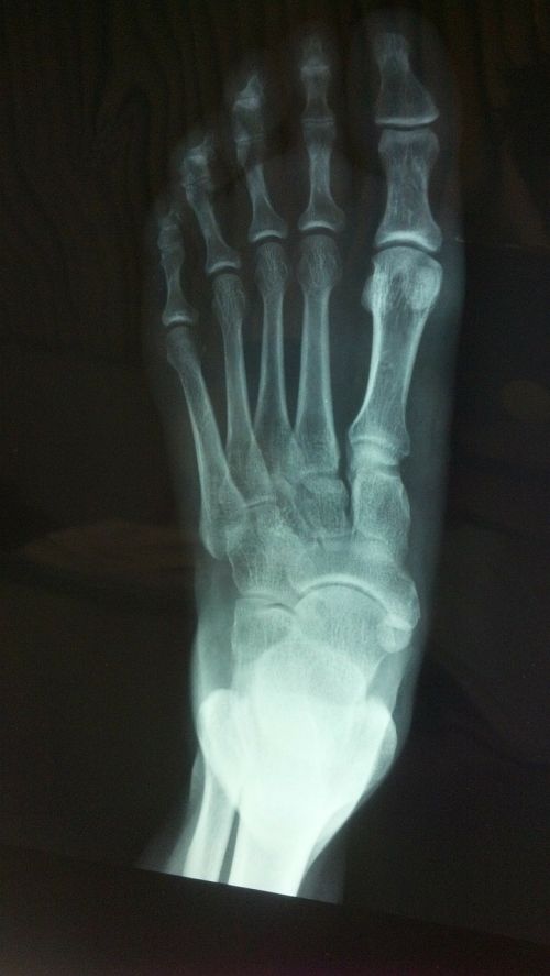 x ray foot bone