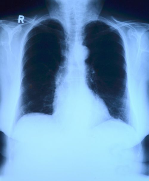 x ray image x ray thorax